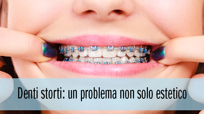 Denti storti: un problema non solo estetico