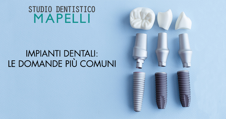 Impianti dentali - le domande più comuni