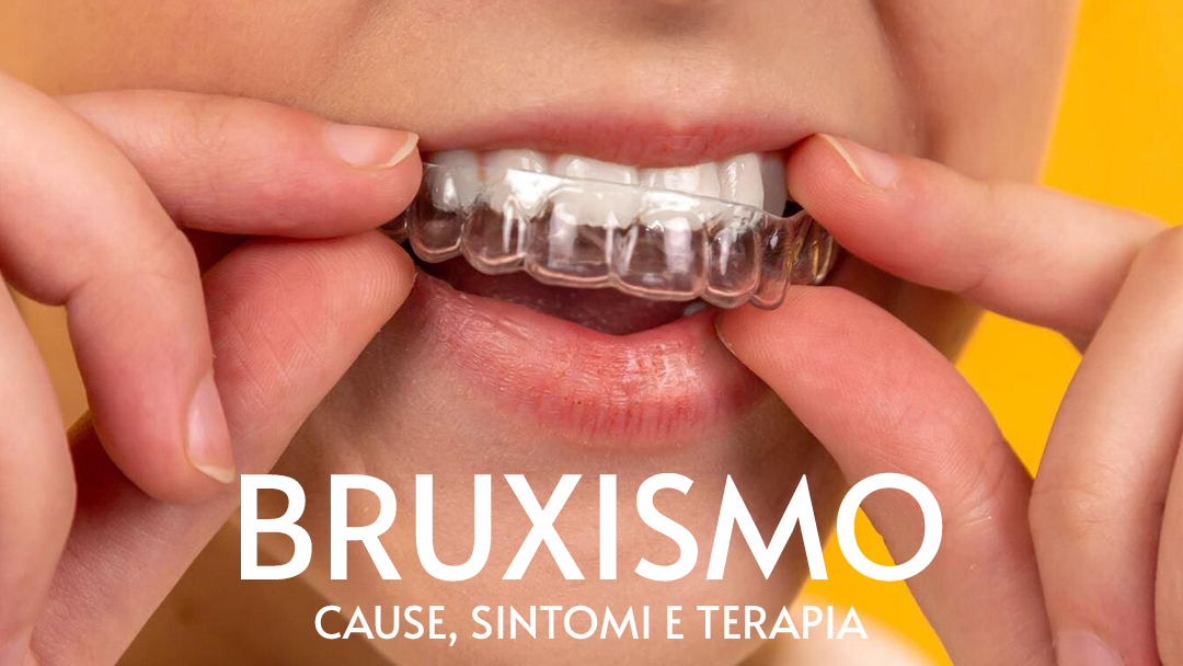 Bruxismo: cause, sintomi e terapia.