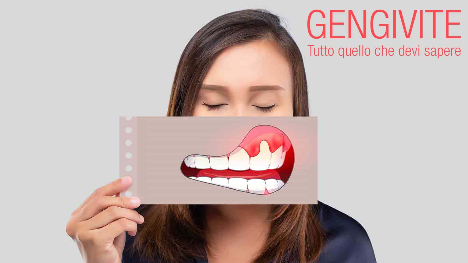 Gengivite - tutto quello che devi sapere