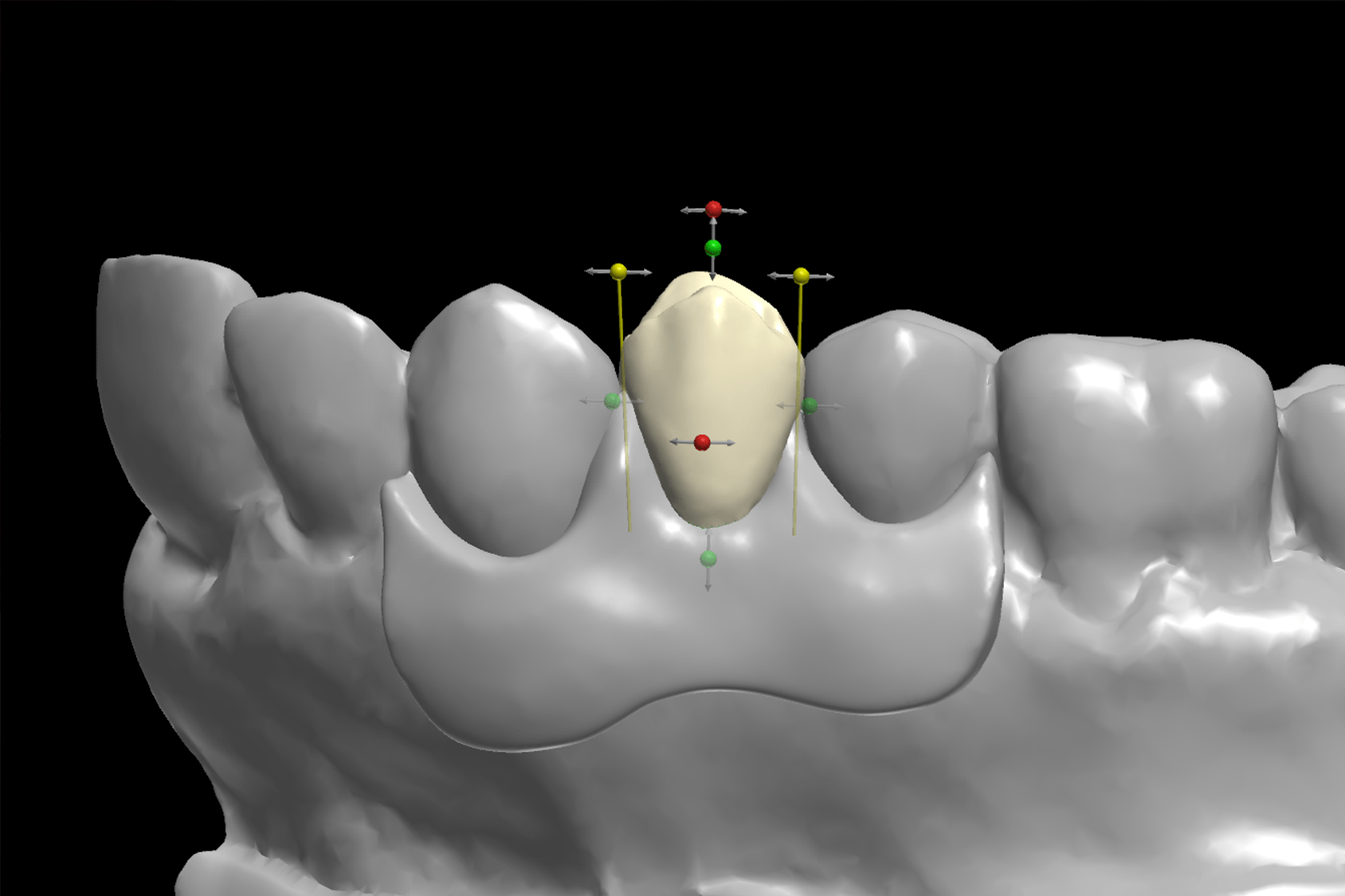 Denti stampati in 3D